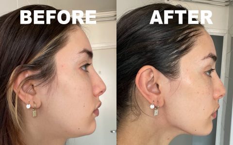 before and after gua sha treatment what happens on your first use skin