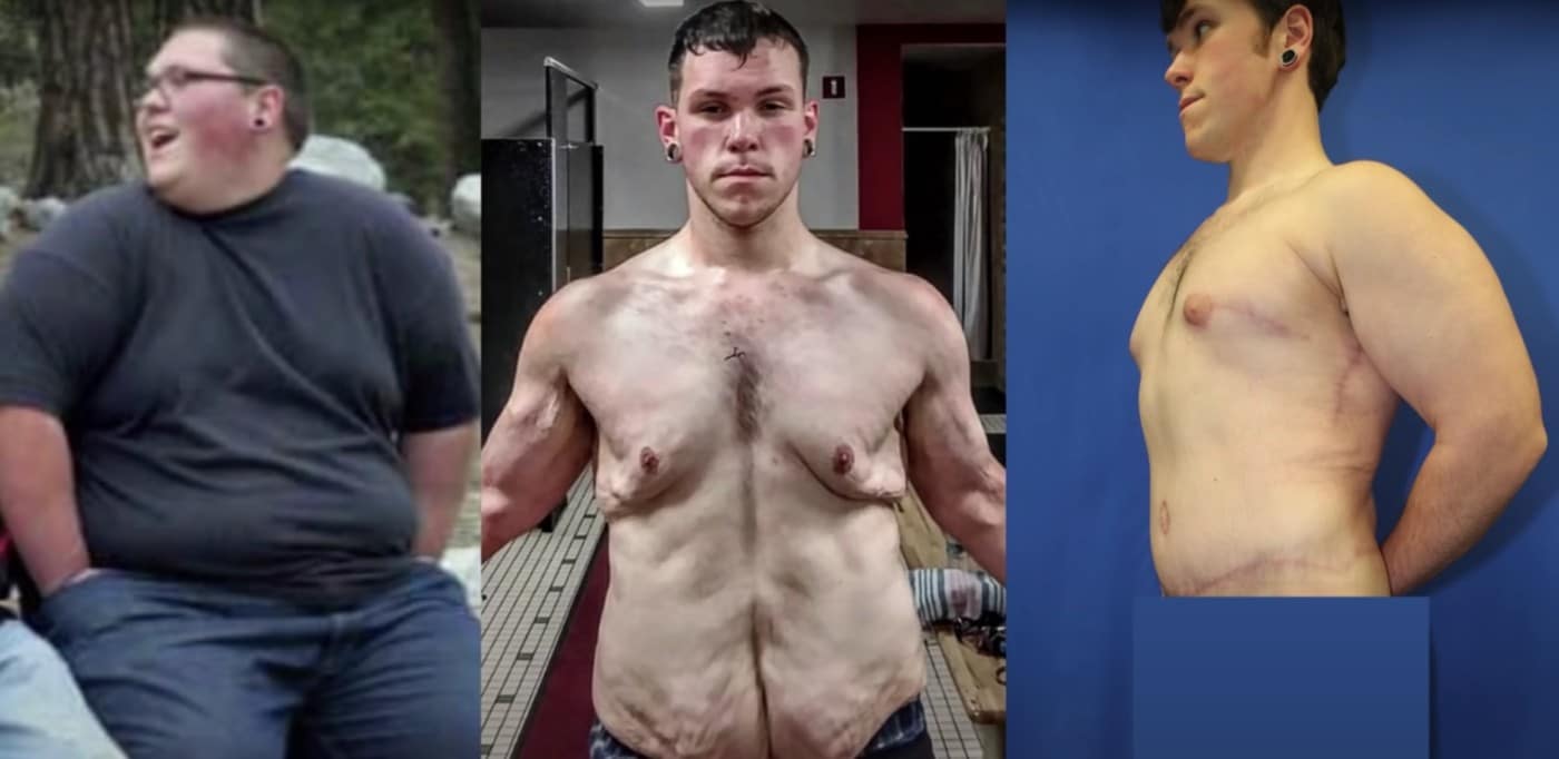 Can you lose 150 pounds without loose skin? Top tips for tight results!